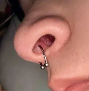 Septum verkeerd