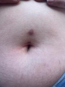 slechte navelpiercing